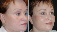 Facelift