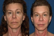 Fat Transfer Full Face with Total FX Laser