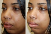 Lip Reduction Surgery.