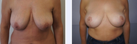 54 Year Old Female Breast Uplift Patient