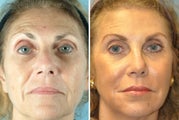 65 Year Old Women Treated for Unwanted Facial Lines