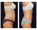 Liposuction