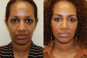 African Rhinoplasty Surgery. 1 month post-op