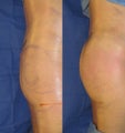 Buttock Augmentation - Brazilian Butt Lift