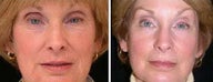 Before and after Traditional CO2 Laser Resurfacing for Wrinkle Removal