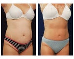 Liposuction