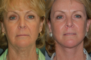 Facelift