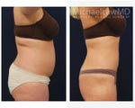 Liposuction