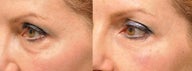 Microcannula Injection of Tear Trough Using Restylane