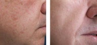 Skin Resurfacing