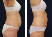 Liposuction