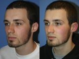 Rhinoplasty