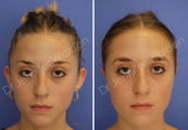 Ear Surgery