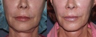 Ulthera Smile Lines | Before and After