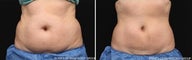 CoolSculpting to Abdomen and Love Handles