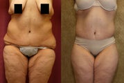 tummy tuck revision to remove dog ears