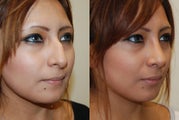 Rhinoplasty Surgery. 5 weeks post-op
