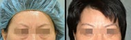 Lower Eyelid(Blepharoplasty) Surgery