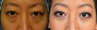 Before and After Bilateral Lower Blepharoplasty Surgery