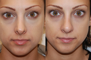 Non-Surgical Nose Job