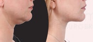 38 year old woman jawline and neck liposuction