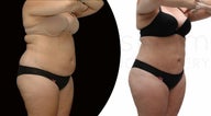 Body-jet Liposuction