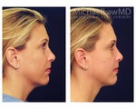 Liposuction