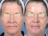 Laser Peel Treatments