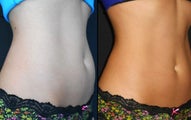 Coolsculpting