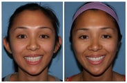 Otoplasty