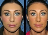 Revision Rhinoplasty