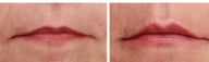 Lip enhancement with hyaluronic acid gel (Juvederm)