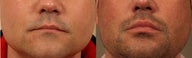 Surgisil Lip Augmentation