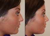 Rhinoplasty, profile view