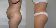 Abdominoplasty and muscle tightening