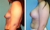 Breast Lift- Mastopexy