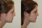 Rhinoplasty Surgery. 6 months post-op.
