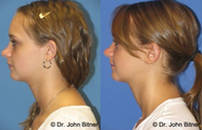 Otoplasty