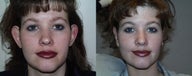 Otoplasty