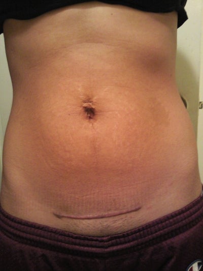 tummy tuck scars after 5 years