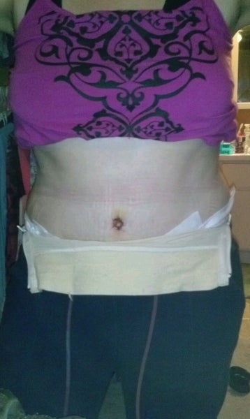 View Muscle Repair Tummy Tuck Images