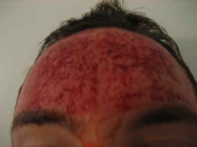 proactiv acne remedy