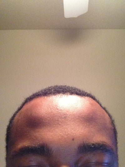 scar in the middle of my forehead