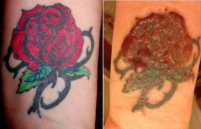 The original tattoo and the tattoo blistered after 2nd session