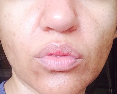 Indian w/dark spots all over my face and dark patches around my mouth 