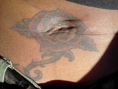 colored tattoo be successfully removed from dark African American skin ...