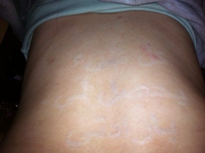Tca Peeling After Tattoo Laser Removal PLEASE Help? (photo) Doctor ...