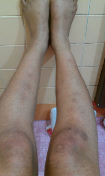 Dark Spots on Legs - Cause and Treatment? Doctor Answers, Tips