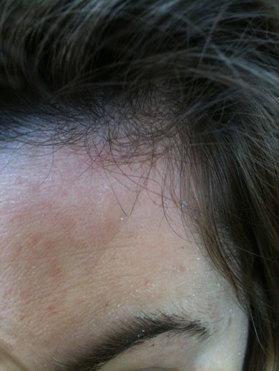 Why Do I Have An Indentation In Forehead After Botox Doctor Answers Tips
