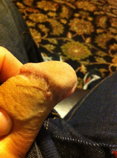 Red Blister On Penis 24